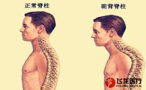 脊柱健康，不向生活“低頭”