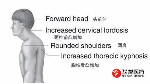 脊柱健康，不向生活“低頭”
